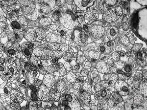 M,26y. | a periphery of a glial scar M,26y. | a periphery of a glial scar